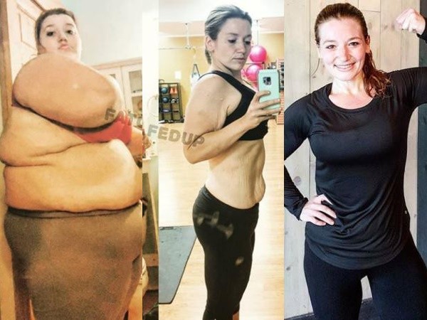 Giảm ngoạn mục 141 kg trong 2 năm, cô gái cắt bỏ tới 3 kg da thừa